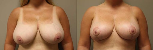breast reduction lift before and after photos by kryger institute of plastic surgery in thousand oaks ca