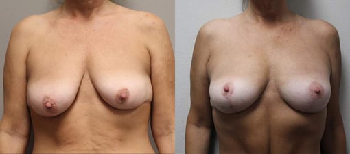 breast reduction lift before and after photos by kryger institute of plastic surgery in thousand oaks ca