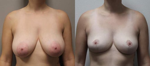 breast reduction lift before and after photos by kryger institute of plastic surgery in thousand oaks ca