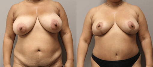 breast reduction lift before and after photos by kryger institute of plastic surgery in thousand oaks ca