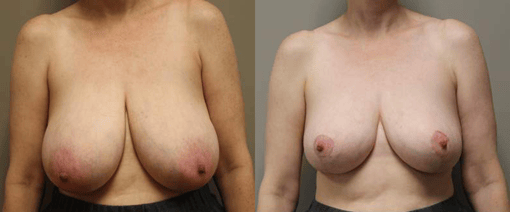 breast reduction lift before and after photos by kryger institute of plastic surgery in thousand oaks ca