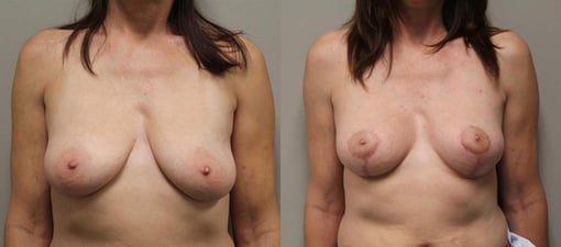 breast reduction lift before and after photos by kryger institute of plastic surgery in thousand oaks ca