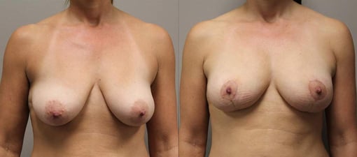 breast reduction lift before and after photos by kryger institute of plastic surgery in thousand oaks ca