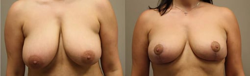 breast reduction lift before and after photos by kryger institute of plastic surgery in thousand oaks ca