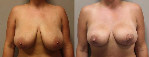 breast reduction lift before and after photos by kryger institute of plastic surgery in thousand oaks ca