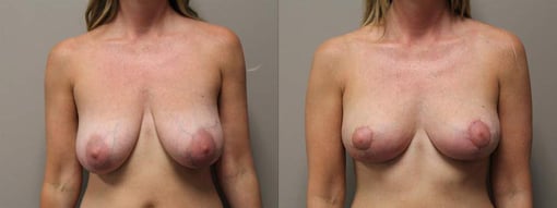 breast reduction lift before and after photos by kryger institute of plastic surgery in thousand oaks ca