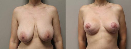 breast reduction lift before and after photos by kryger institute of plastic surgery in thousand oaks ca