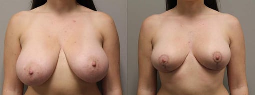 breast reduction lift before and after photos by kryger institute of plastic surgery in thousand oaks ca