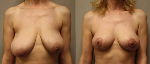 breast reduction lift before and after photos by kryger institute of plastic surgery in thousand oaks ca