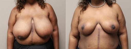 breast reduction lift before and after photos by kryger institute of plastic surgery in thousand oaks ca