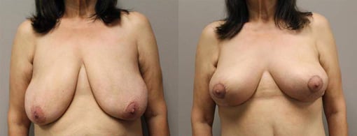 breast reduction lift before and after photos by kryger institute of plastic surgery in thousand oaks ca