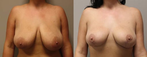 breast reduction lift before and after photos by kryger institute of plastic surgery in thousand oaks ca