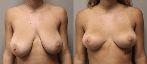 breast reduction lift before and after photos by kryger institute of plastic surgery in thousand oaks ca