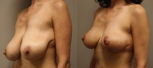 breast reduction lift before and after photos by kryger institute of plastic surgery in thousand oaks ca