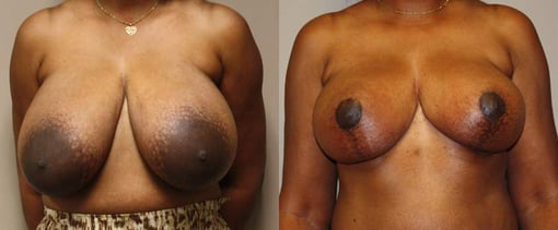 breast reduction lift before and after photos by kryger institute of plastic surgery in thousand oaks ca
