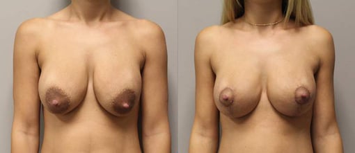 breast reduction lift before and after photos by kryger institute of plastic surgery in thousand oaks ca
