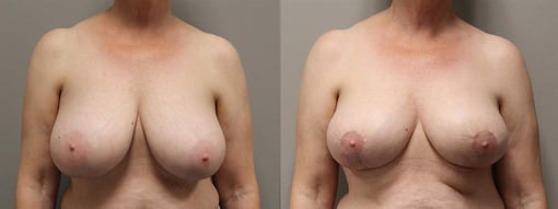 breast reduction lift before and after photos by kryger institute of plastic surgery in thousand oaks ca