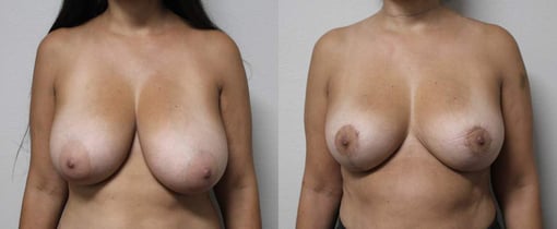 breast reduction lift before and after photos by kryger institute of plastic surgery in thousand oaks ca