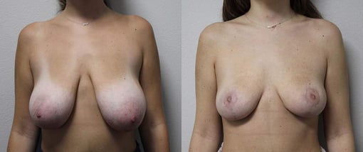 breast reduction lift before and after photos by kryger institute of plastic surgery in thousand oaks ca