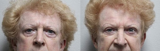brow lift before and after photos by kryger institute of plastic surgery in thousand oaks ca