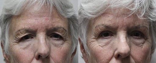 brow lift before and after photos by kryger institute of plastic surgery in thousand oaks ca