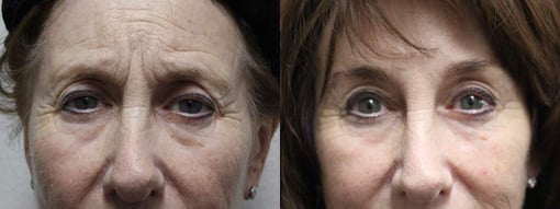 brow lift before and after photos by kryger institute of plastic surgery in thousand oaks ca