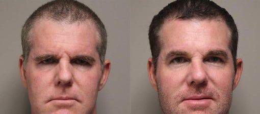 brow lift before and after photos by kryger institute of plastic surgery in thousand oaks ca