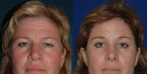 brow lift before and after photos by kryger institute of plastic surgery in thousand oaks ca