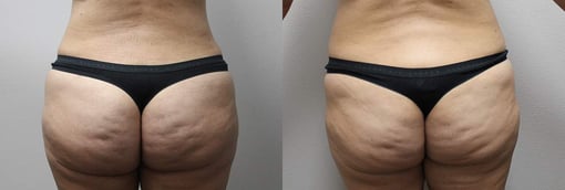 buttocks brazilian butt lift before and after photos by kryger institute of plastic surgery in thousand oaks ca