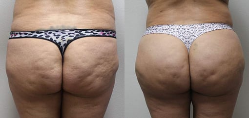 buttocks brazilian butt lift before and after photos by kryger institute of plastic surgery in thousand oaks ca