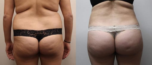 buttocks brazilian butt lift before and after photos by kryger institute of plastic surgery in thousand oaks ca