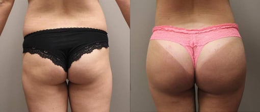 buttocks brazilian butt lift before and after photos by kryger institute of plastic surgery in thousand oaks ca