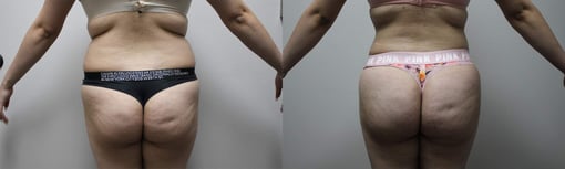 buttocks brazilian butt lift before and after photos by kryger institute of plastic surgery in thousand oaks ca