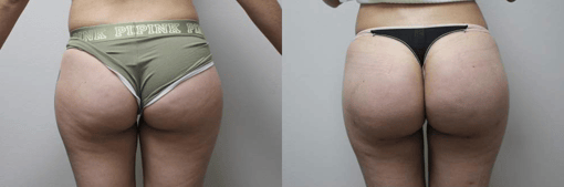 buttocks brazilian butt lift before and after photos by kryger institute of plastic surgery in thousand oaks ca