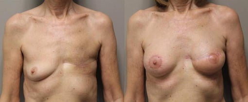 delayed reconstruction before and after photos by kryger institute of plastic surgery in thousand oaks ca