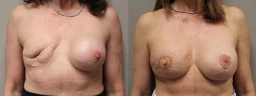 delayed reconstruction before and after photos by kryger institute of plastic surgery in thousand oaks ca