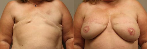 delayed reconstruction before and after photos by kryger institute of plastic surgery in thousand oaks ca