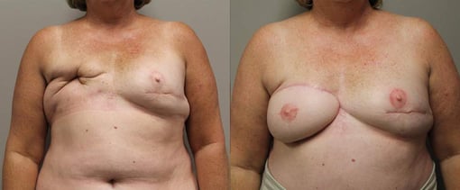 delayed reconstruction before and after photos by kryger institute of plastic surgery in thousand oaks ca