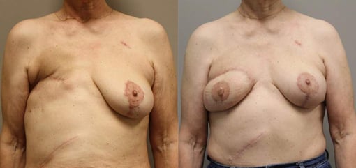delayed reconstruction before and after photos by kryger institute of plastic surgery in thousand oaks ca