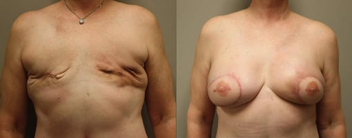 delayed reconstruction before and after photos by kryger institute of plastic surgery in thousand oaks ca