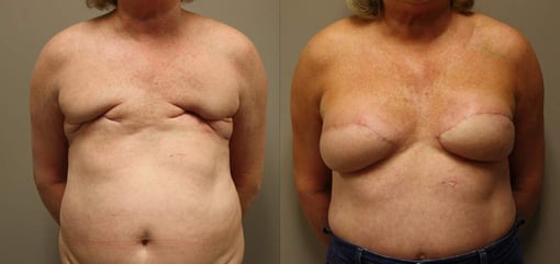 delayed reconstruction before and after photos by kryger institute of plastic surgery in thousand oaks ca