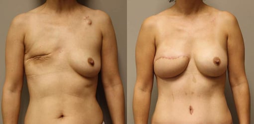 delayed reconstruction before and after photos by kryger institute of plastic surgery in thousand oaks ca
