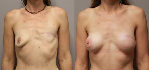 delayed reconstruction before and after photos by kryger institute of plastic surgery in thousand oaks ca