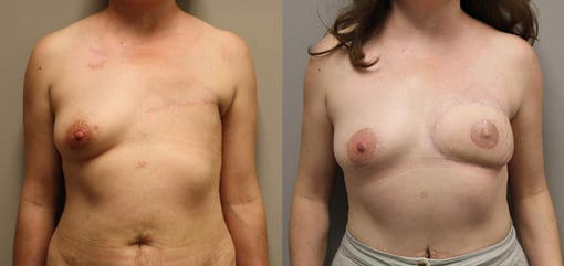 delayed reconstruction before and after photos by kryger institute of plastic surgery in thousand oaks ca