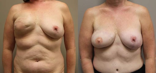 delayed reconstruction before and after photos by kryger institute of plastic surgery in thousand oaks ca