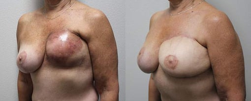 diep flap reconstruction before and after photos by kryger institute of plastic surgery in thousand oaks ca