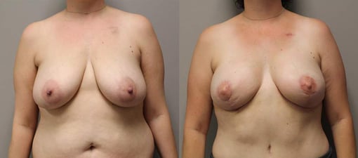 diep flap reconstruction before and after photos by kryger institute of plastic surgery in thousand oaks ca