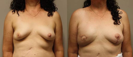 diep flap reconstruction before and after photos by kryger institute of plastic surgery in thousand oaks ca