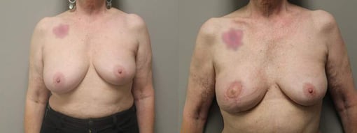 diep flap reconstruction before and after photos by kryger institute of plastic surgery in thousand oaks ca