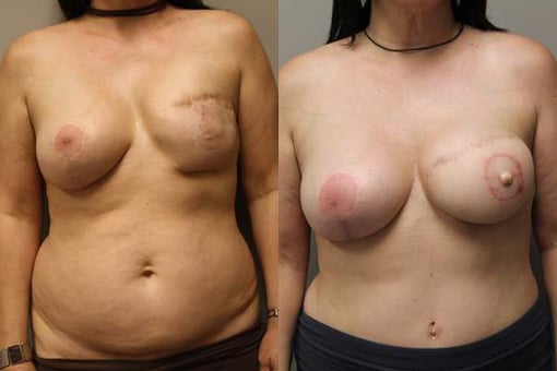 diep flap reconstruction before and after photos by kryger institute of plastic surgery in thousand oaks ca